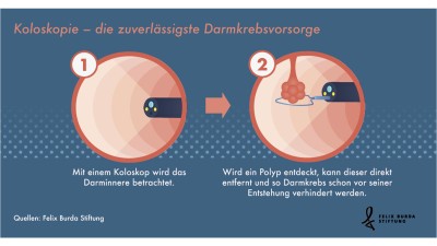 Schaubild Koloskopie