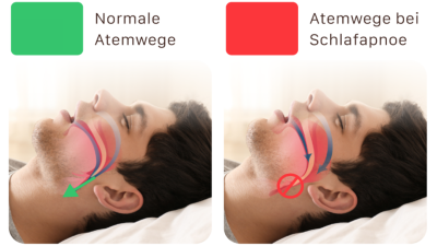 Vergleich von normalen Atemwegen und Atemwegen bei Schlafapnoe.